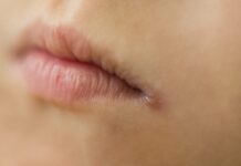 입가에 ‘뾰루지 물집’ 생겼는데…선크림 발라도 될까?